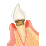歯周病の進行